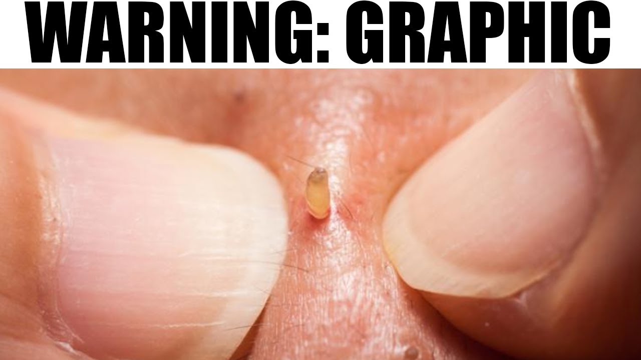 Blister Popping, Tonsil Stones, Open Comedones, Fissured Tongues & Blackhead King
