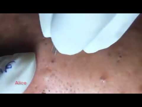Bloody Blackhead Removal – Brutal pimple popping // deep bloody blackheads