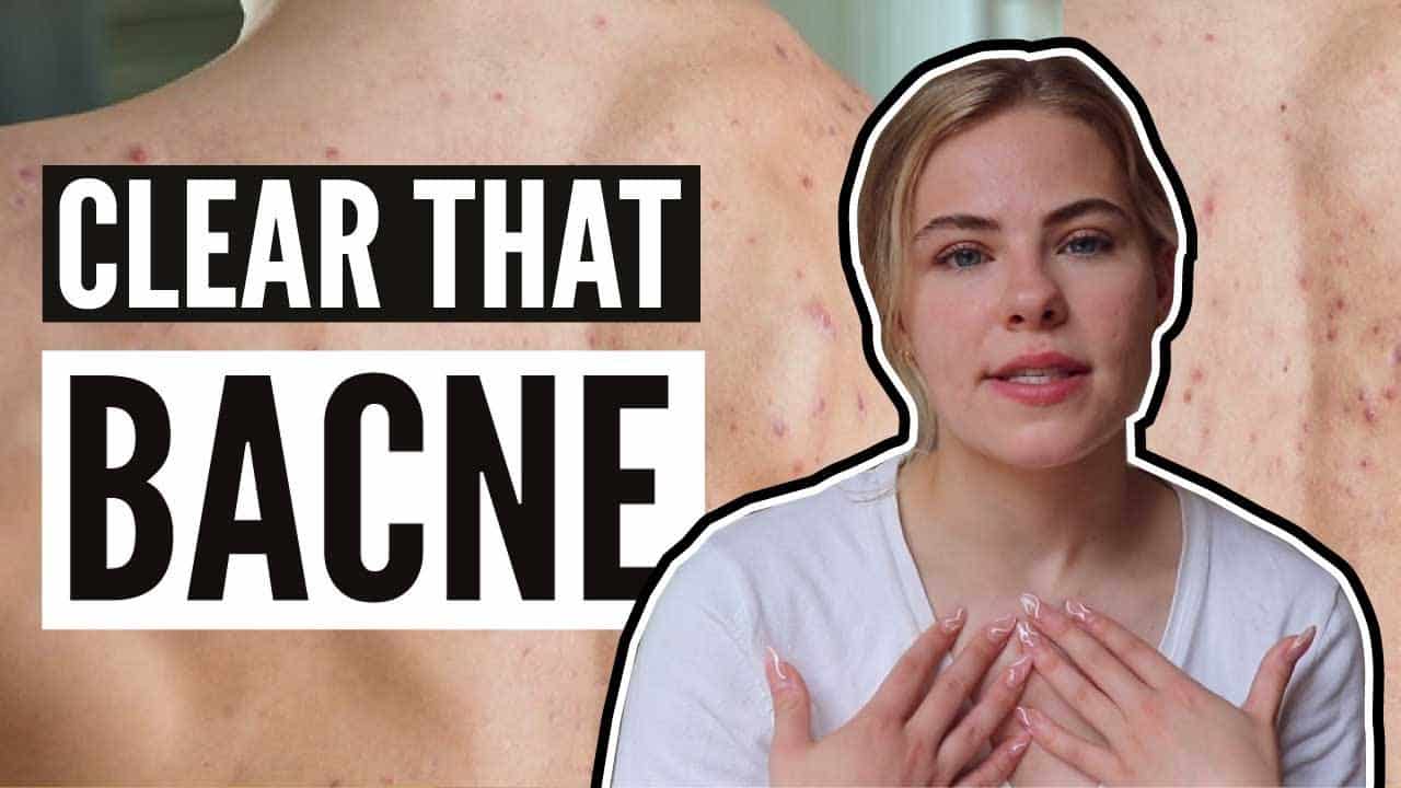 Body Acne Treatment – 7 Easy Tips That You SHOULD Try Right Now!