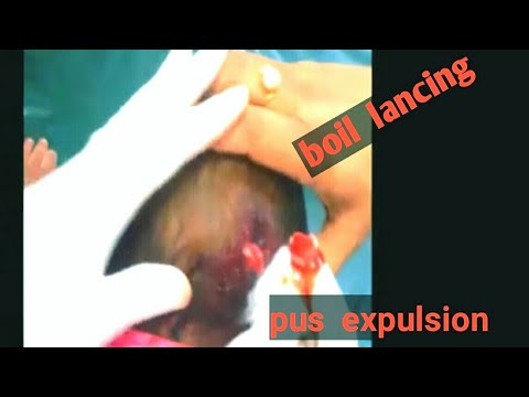 Boil  lancing  and  pus  expulsion!! 4 month old infant  …!! Minor  OT .. ||