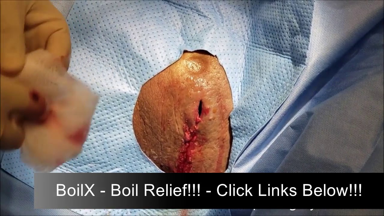Boil on Inner Thigh Near Groin Male Treatment??? – BoilX – Homeopathic Boils Relief Available!!!