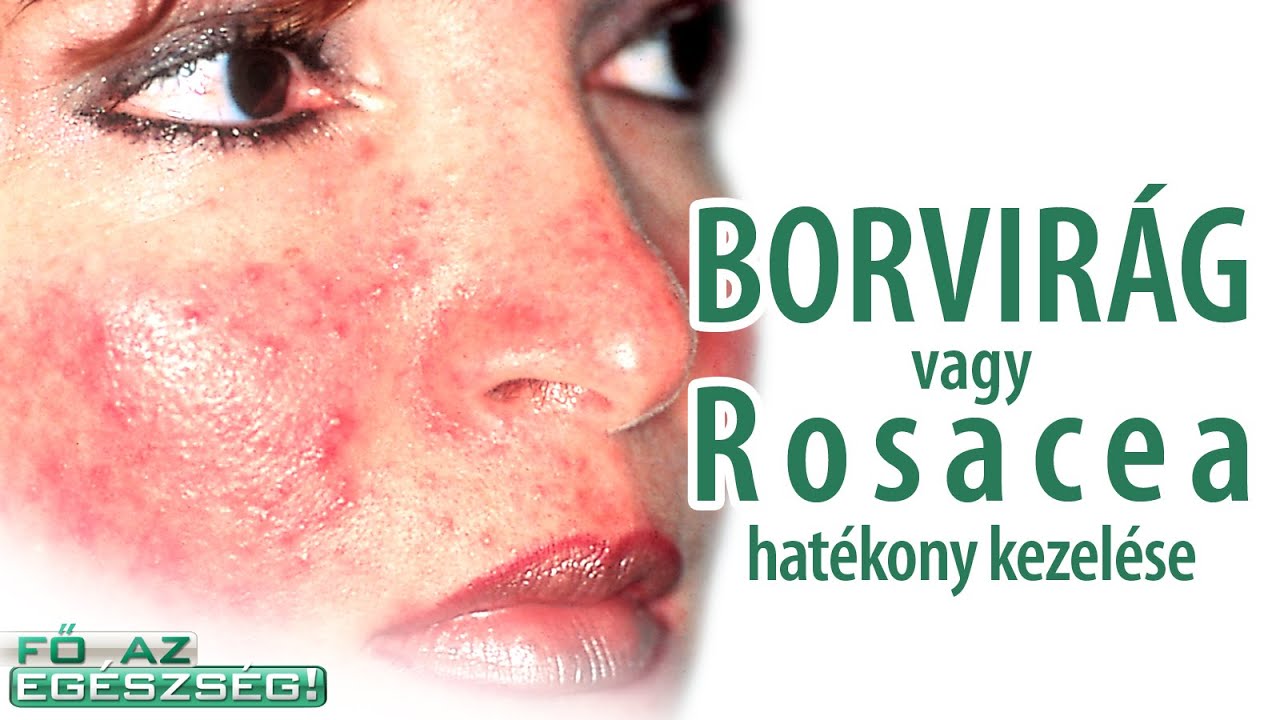 Borvirágos bőr, vagyis a Rosacea és visszér hatékony kezelése – Fő az egészség!