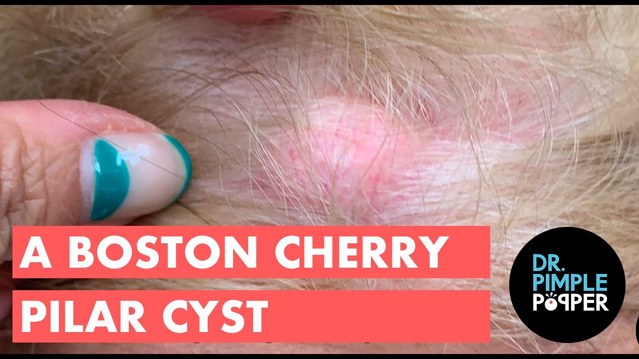 Boston Cherry Pilar Cyst