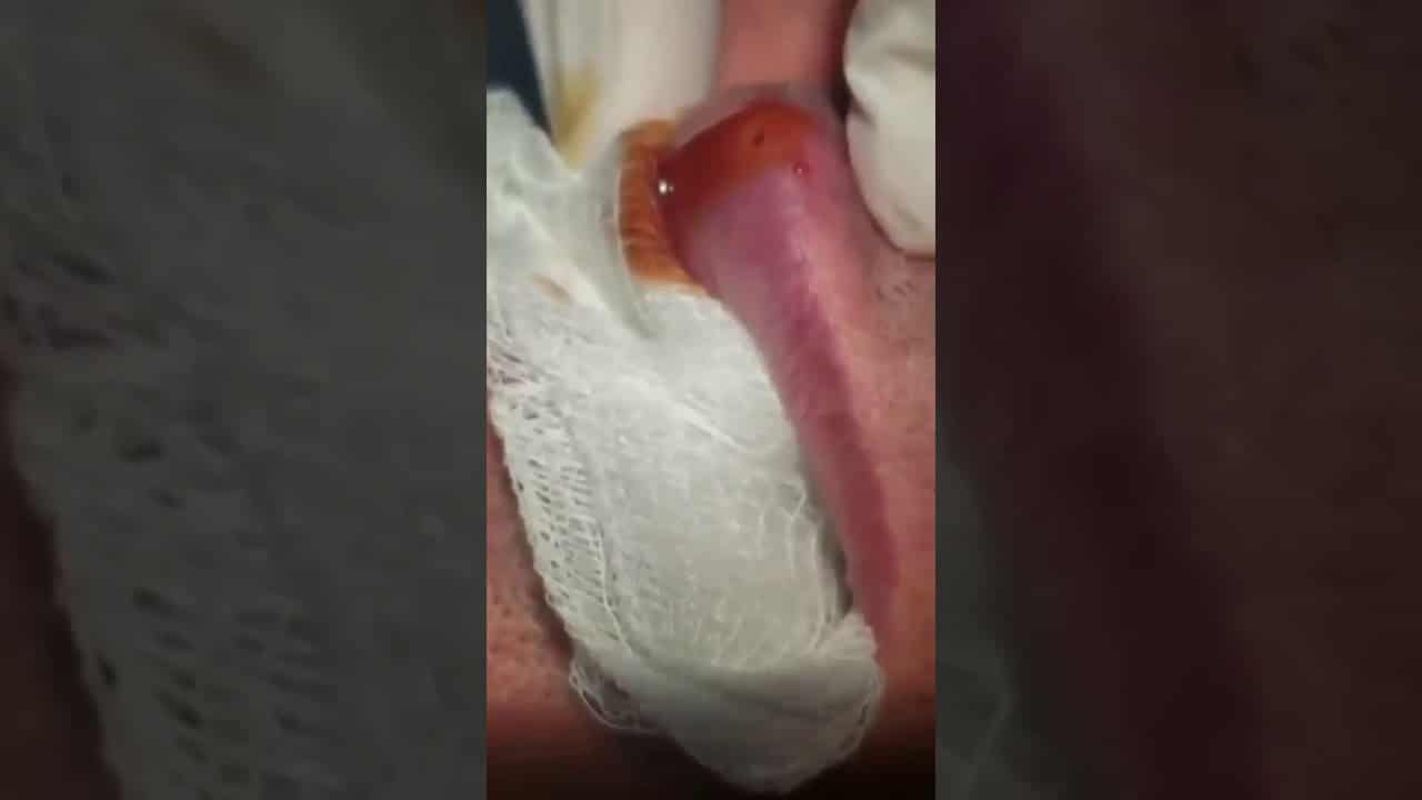 Botfly (pimple popping ) subscribe ?