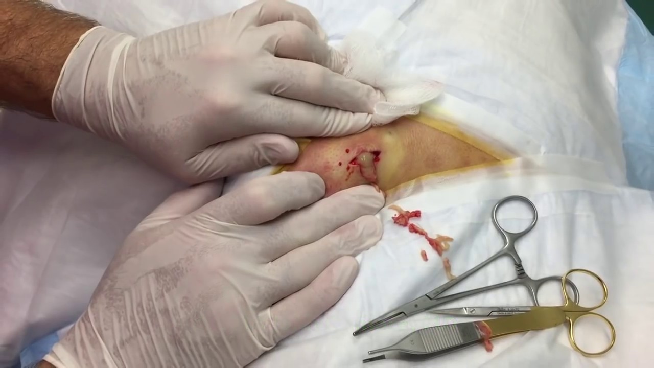 Bruce's Infected Cyst, Double-Super Slow Motion!