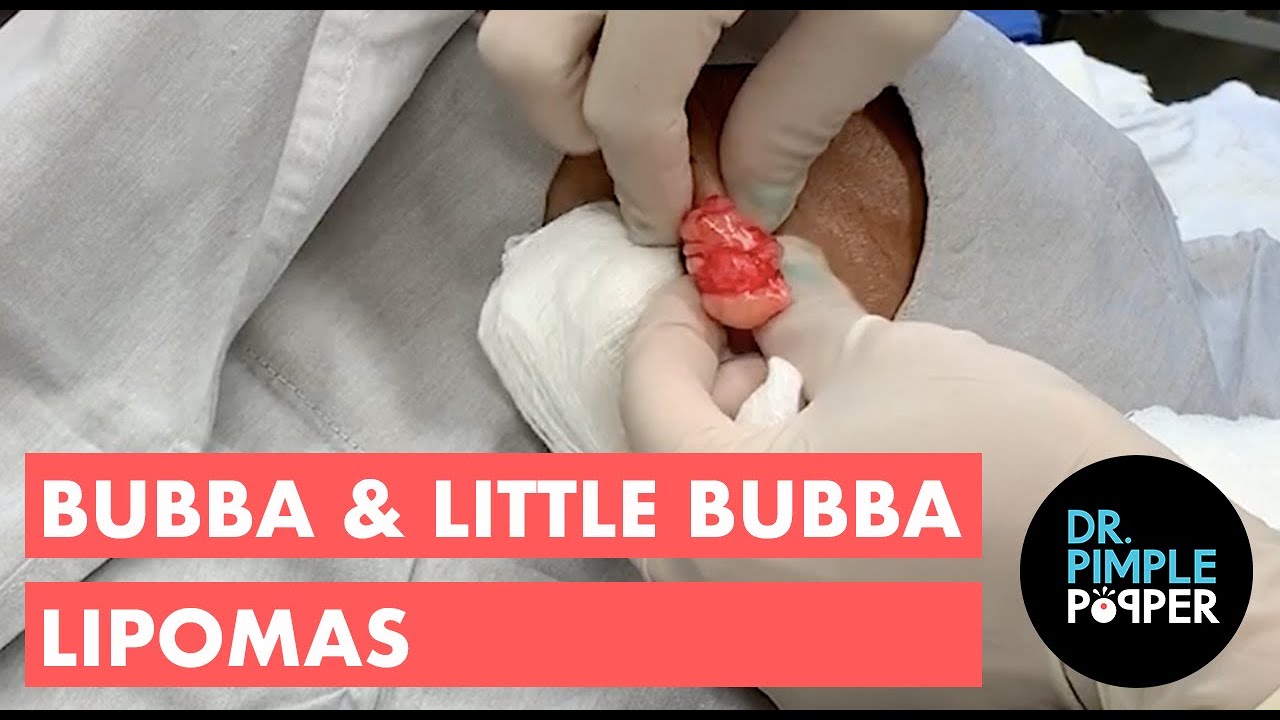 Bubba & Little Bubba Lipomas