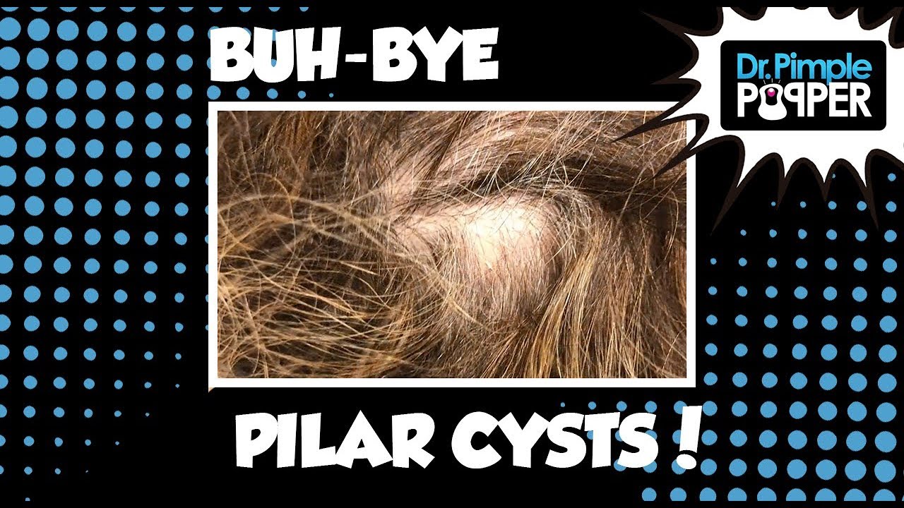 Buh-Bye Pilar Cysts!