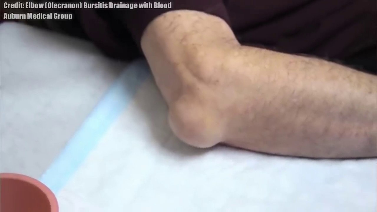 Bursitis & Cysts (Not an Elbow Cyst video!)