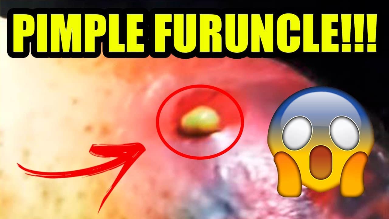 Bursting a pimple with furuncle – Cyst Treatment 2021 [ABSCESS CYST REMOVAL]