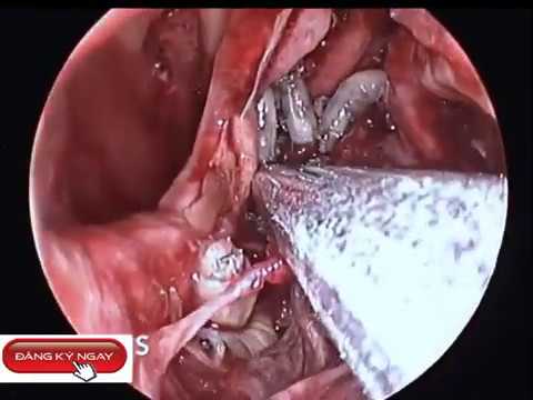 Cận cảnh gắp giòi ra khỏi cơ thể người phần1. Close-up of maggots removed from the human body part1.