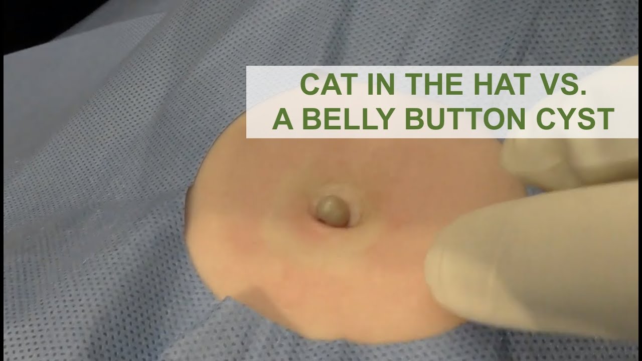Cat in the Hat vs. A Belly Button Cyst | Dr. Derm