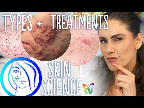Causes & Treatment For Cystic Acne, Whiteheads & Blackheads. | Skin Science Ep.