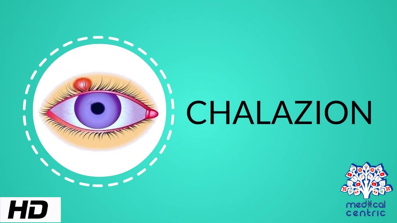 CHALAZION, Causes, Signs and Symptoms, Diagnosis and Treatment.