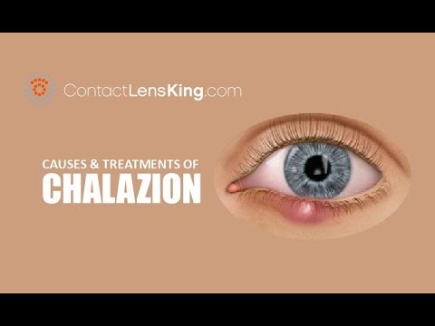 Chalazion | Causes, Treatment and Surgery