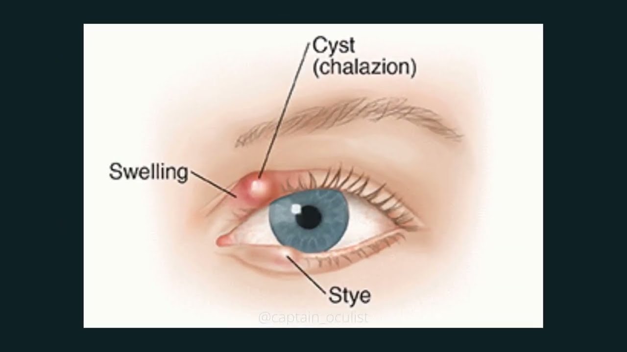 chalazion | eye stye | pimple on eyelid | eye stye causes | eye pimple causes & treatment