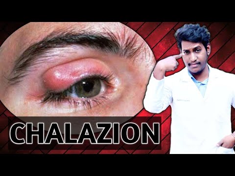 chalazion in hindi ||chalazion treatment || chalazion lecture || chalazion ~2021