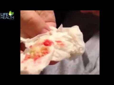 Cheese cyst squeeze , pimple popping with scissors   Life & Health Network