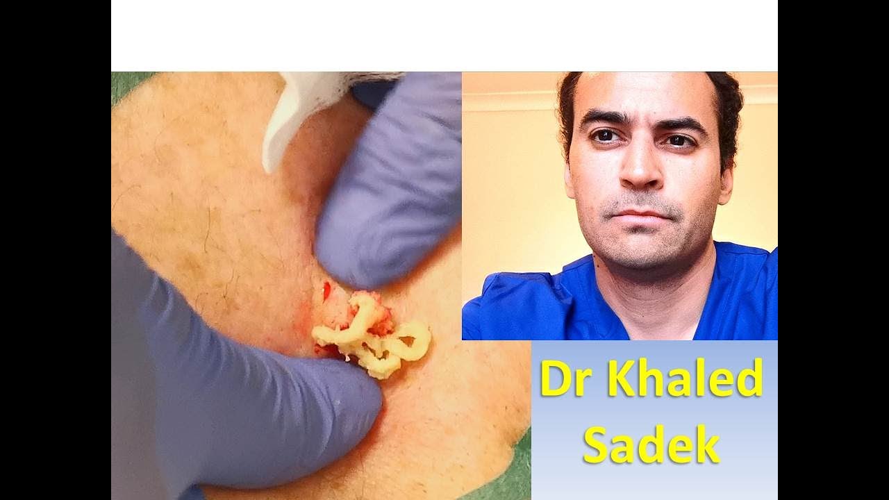 Cheesy Cyst Dr Khaled Sadek. LipomaCyst.com