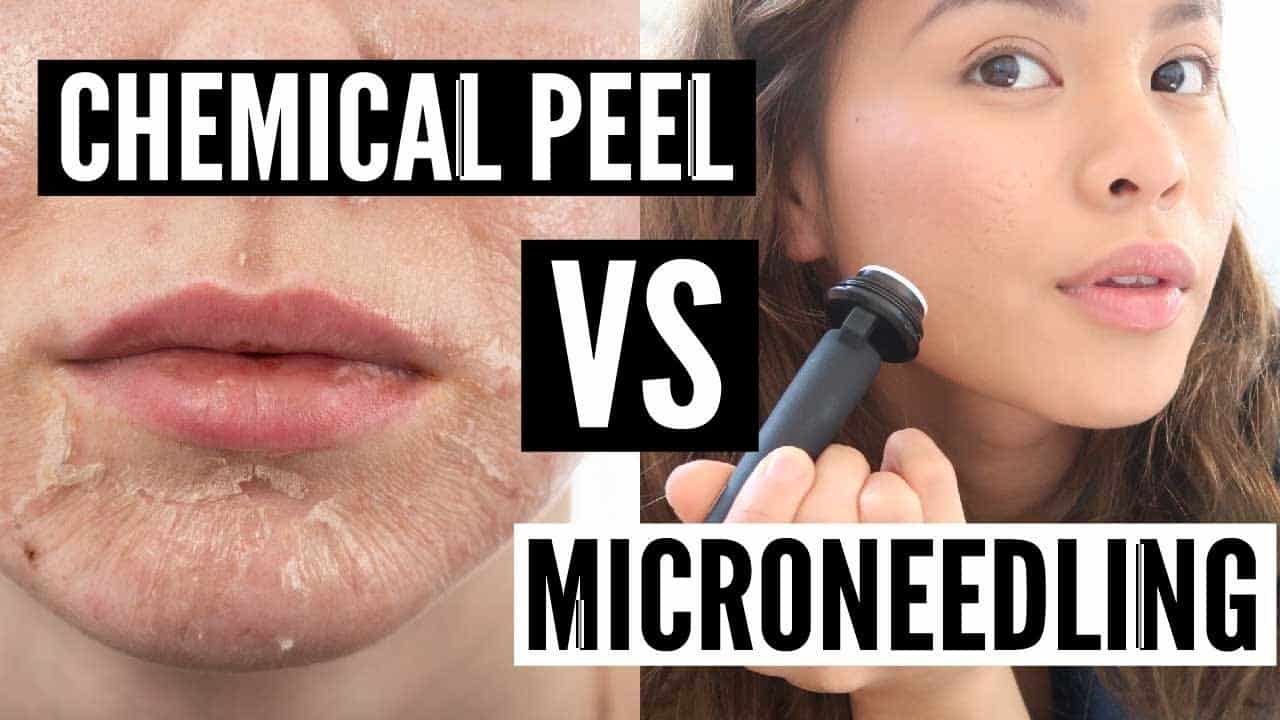 Chemical Peel VS Microneedling