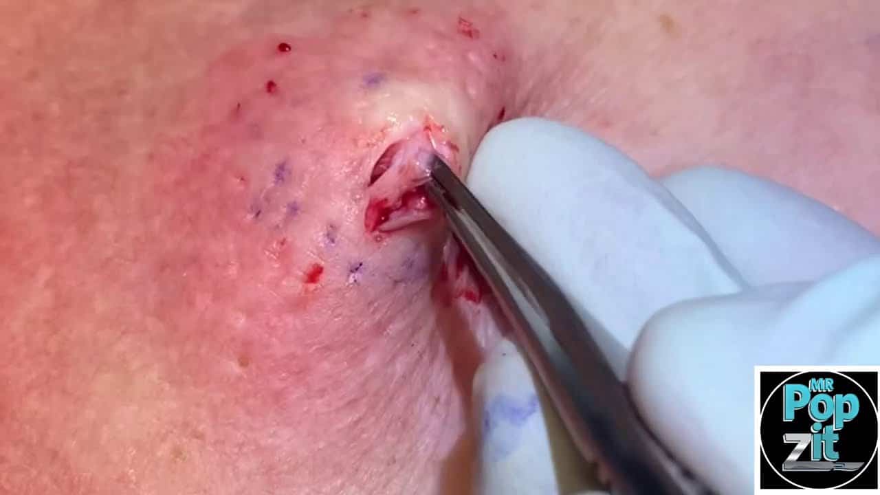 Chest popper blackhead with underlying cyst. Big squeeze and cyst pop. Full excision and closure.
