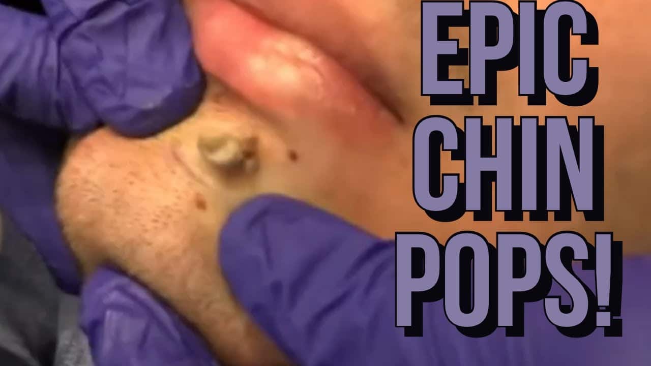 Chin Pimples And Zits | Facial Acne 2020 | The BEST Chin Extractions