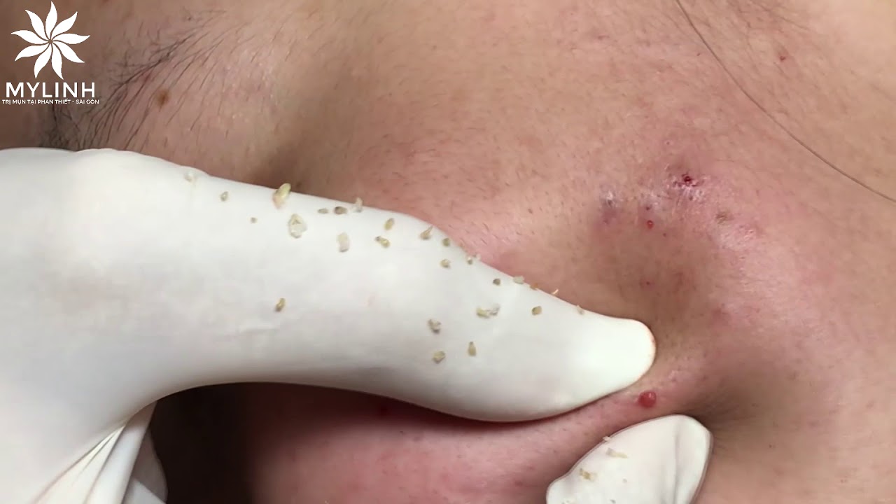 CLEAN ACNE POPPING #3
