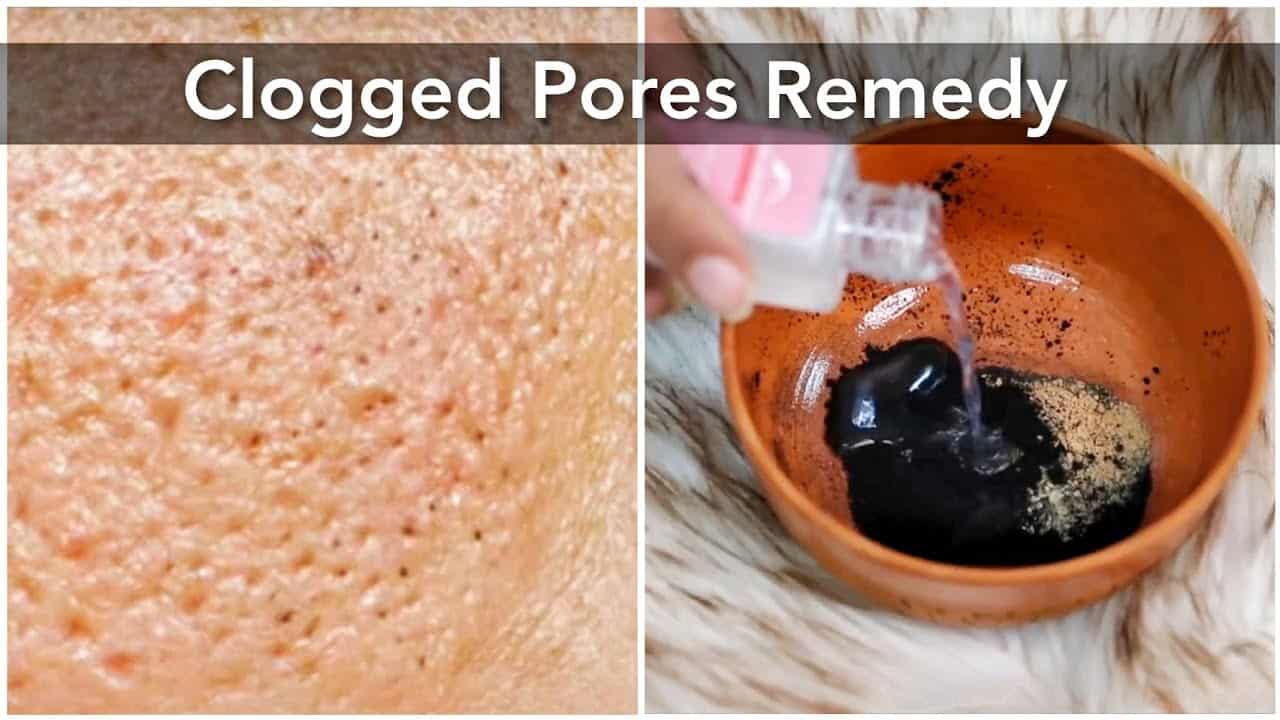 Clean Clogged Pores | Home Remedy For Whiteheads & Blackheads