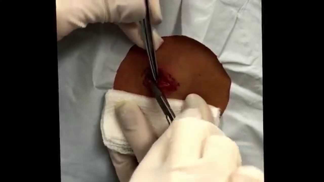 Clean cyst excision. For medical education- NSFE.