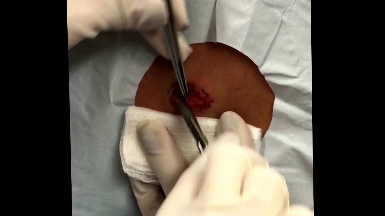 Clean cyst excision. For medical education- NSFE.