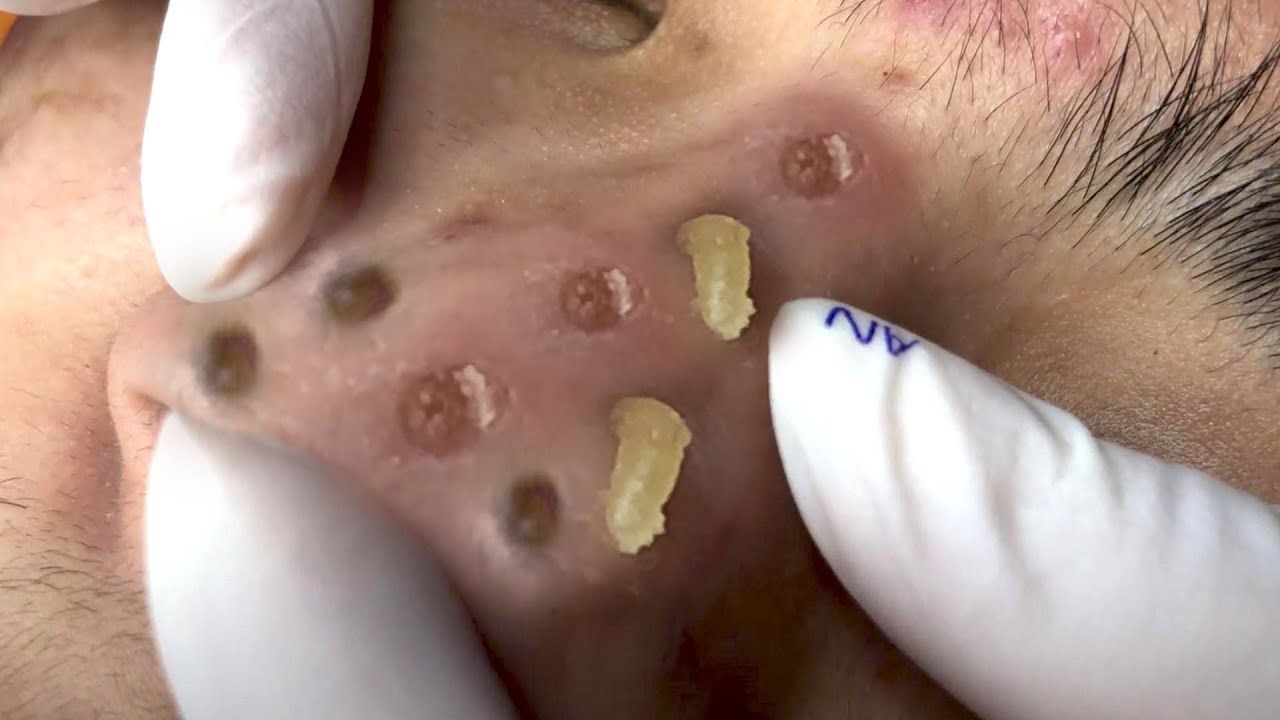Clean Giant Blackheads on Nose