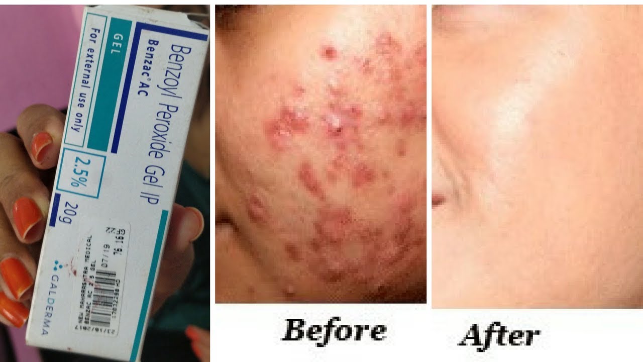 इससे होंगे पिंपल्स खत्म | Clear Acne Pimples once and for all – best solution for acne RabiaSkincare