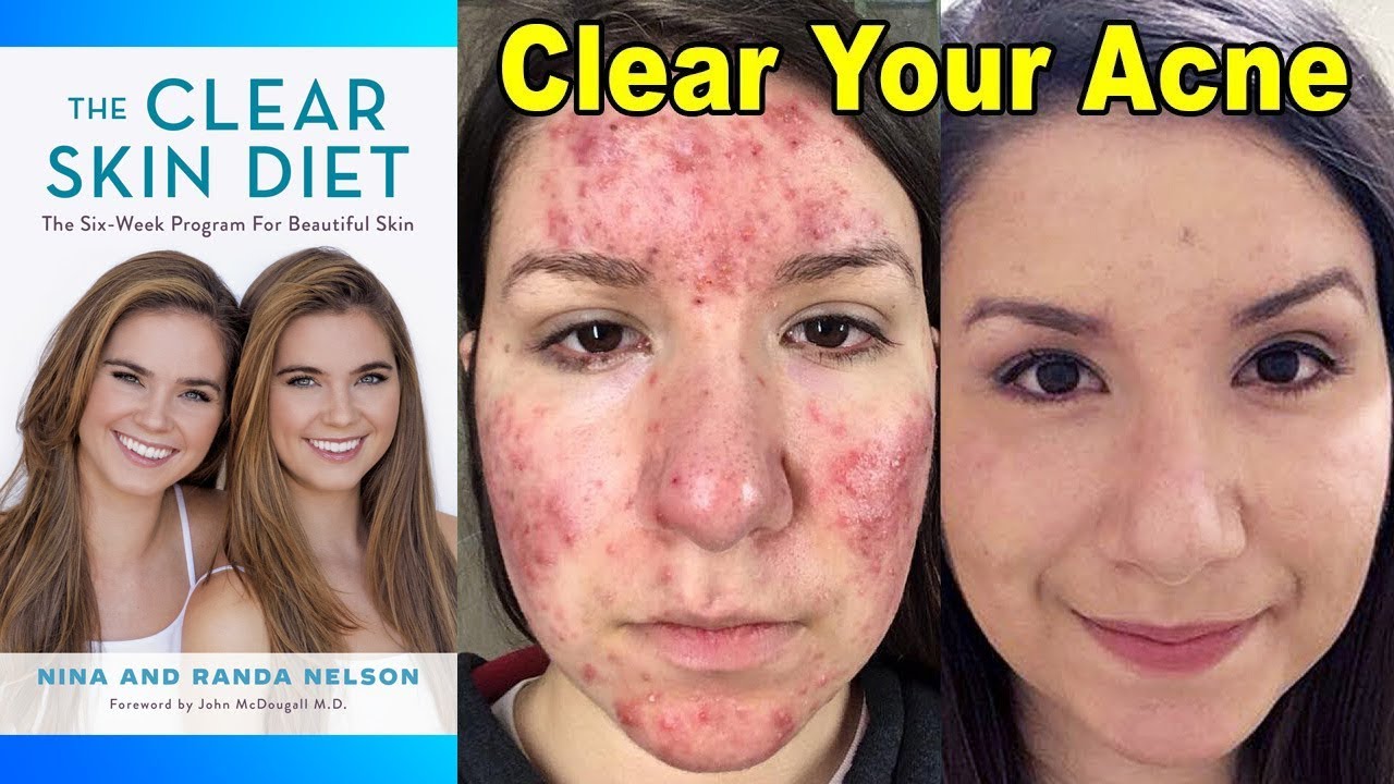 Clear Cystic Acne with Diet – Nina & Randa