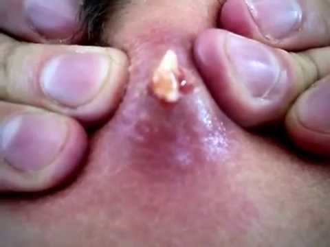 Close up of ENORMOUS ZIT popping – more of the brain