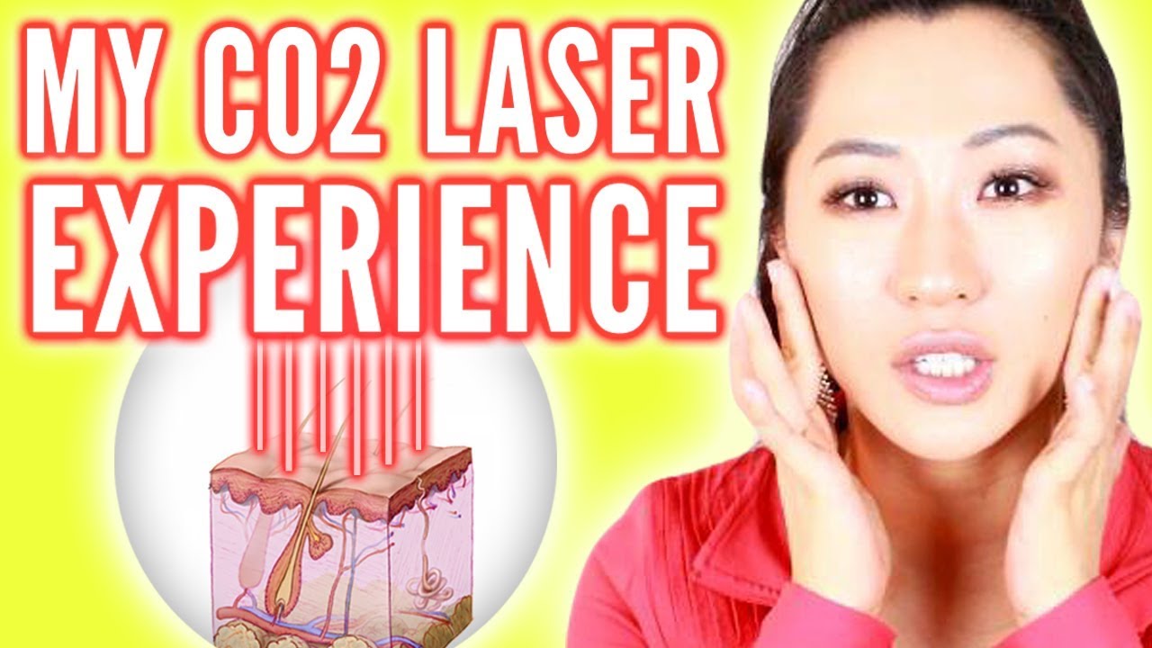 CO2 Laser for Acne Scars! Was it Worth it?