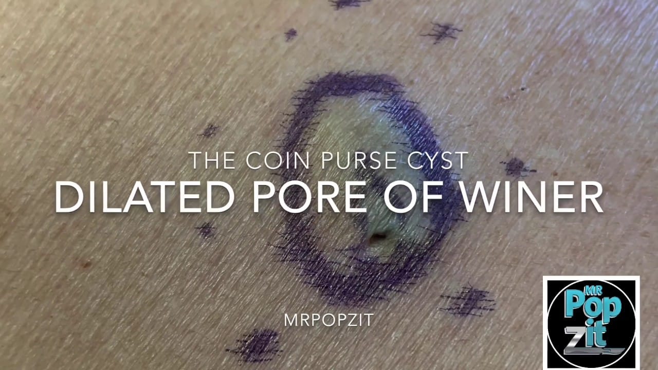 Coin purse cyst. Large Dilated Pore of Winer. Flat Horizontal cyst growing sideways.DPOW MrPopZit