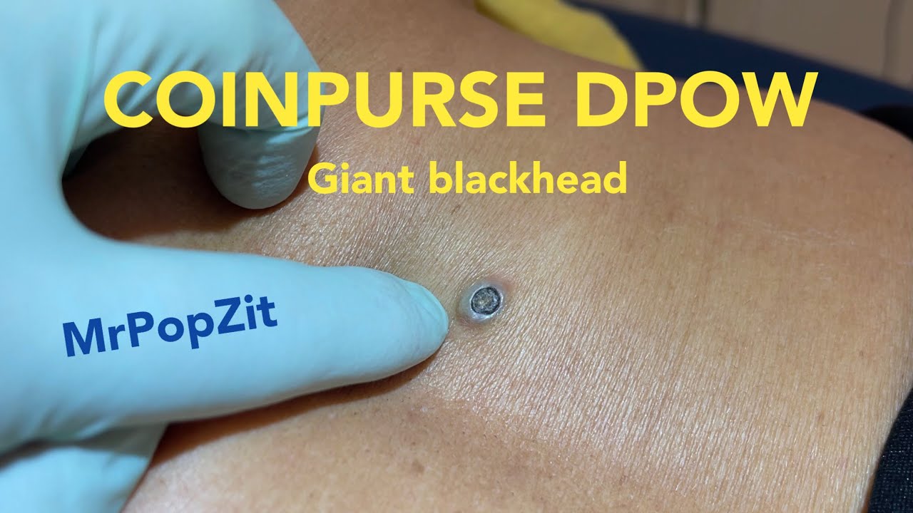 Coinpurse DPOW. Giant blackhead removed. Extended down to fat tissue below. Punch excision.MrPopZit