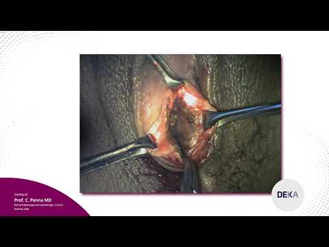 COLPOSCOPY – Cysts of Bartholin’s glands (patient 2)