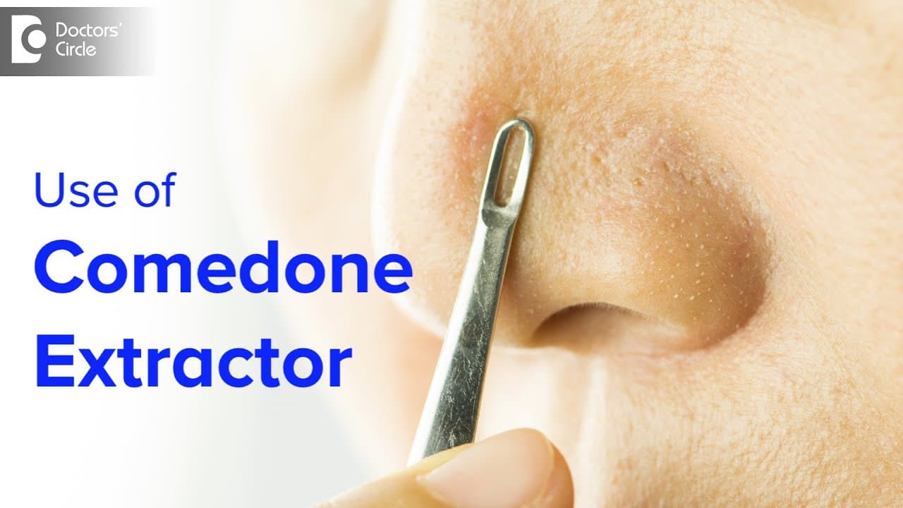 Comedone Extractor for Blackhead, Whitehead at home-Is it safe?- Dr. Rajdeep Mysore| Doctors' Circle