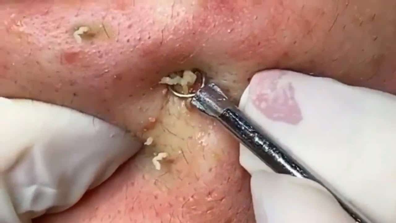 Comedone Extractor Tools!  What are Pimple Popping Tools?
