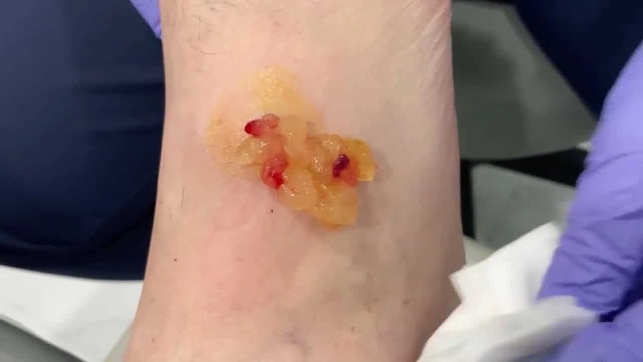 Compilation 17: #GANGLION #CYSTS #popping #drainage and #surgery #cystremoval