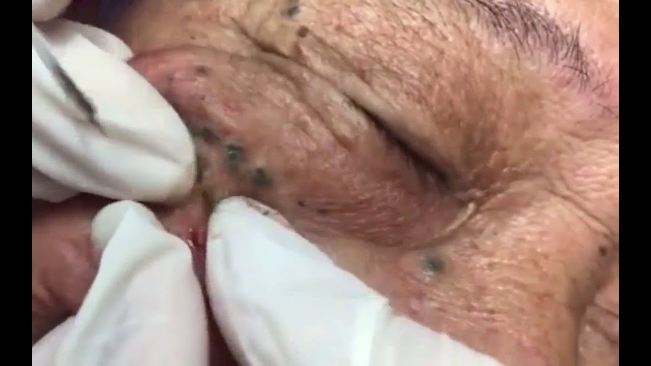 Compilation of relaxing pimple popping on and around eye
