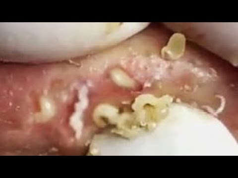 Compilation of relaxing pimple popping