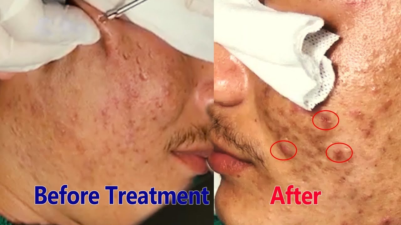 compilation video#2 pimple acne and blackhead removal white acne popping  natural treatment product