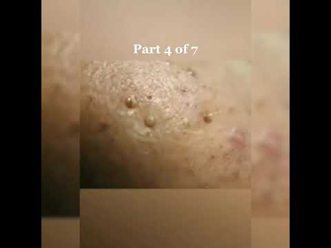 Compilation Whitehead's Pimple popping Acne