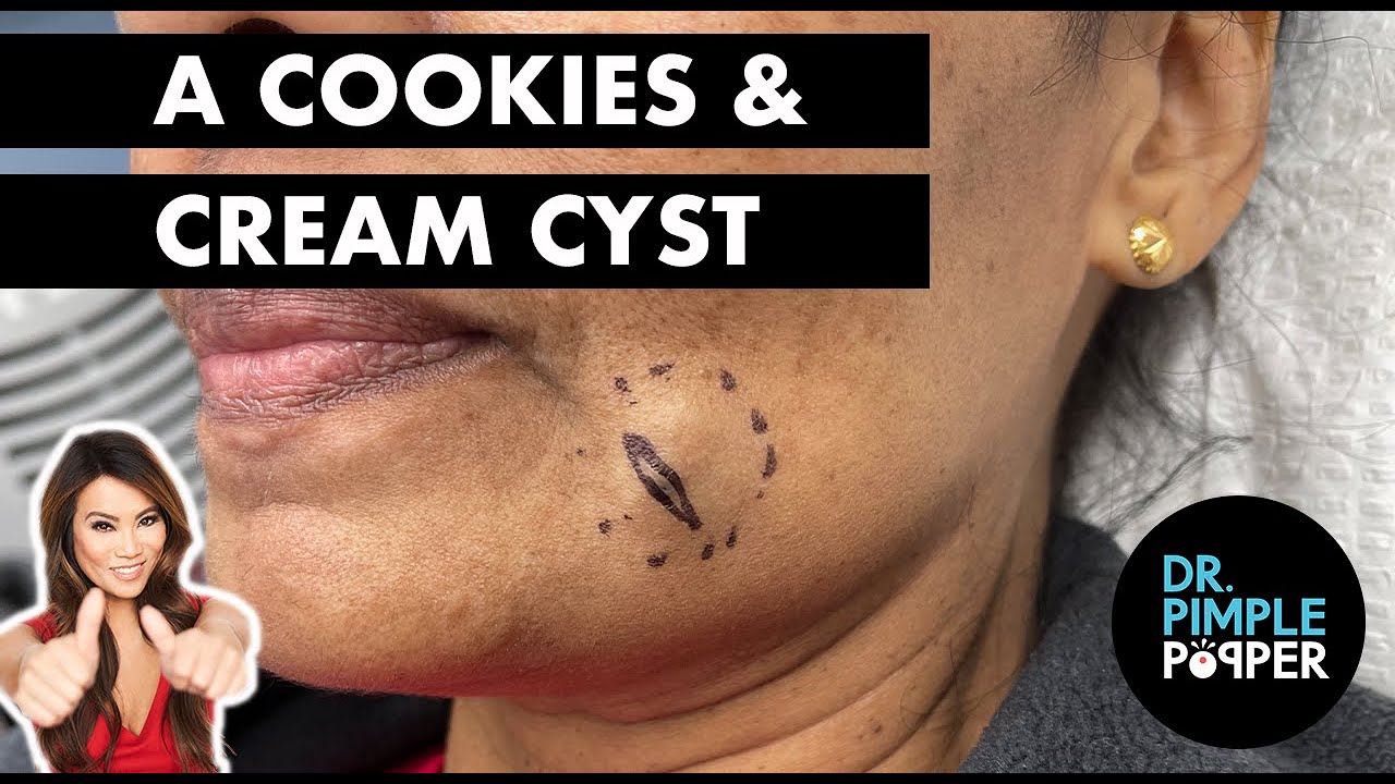 Cookies & Cream Cyst
