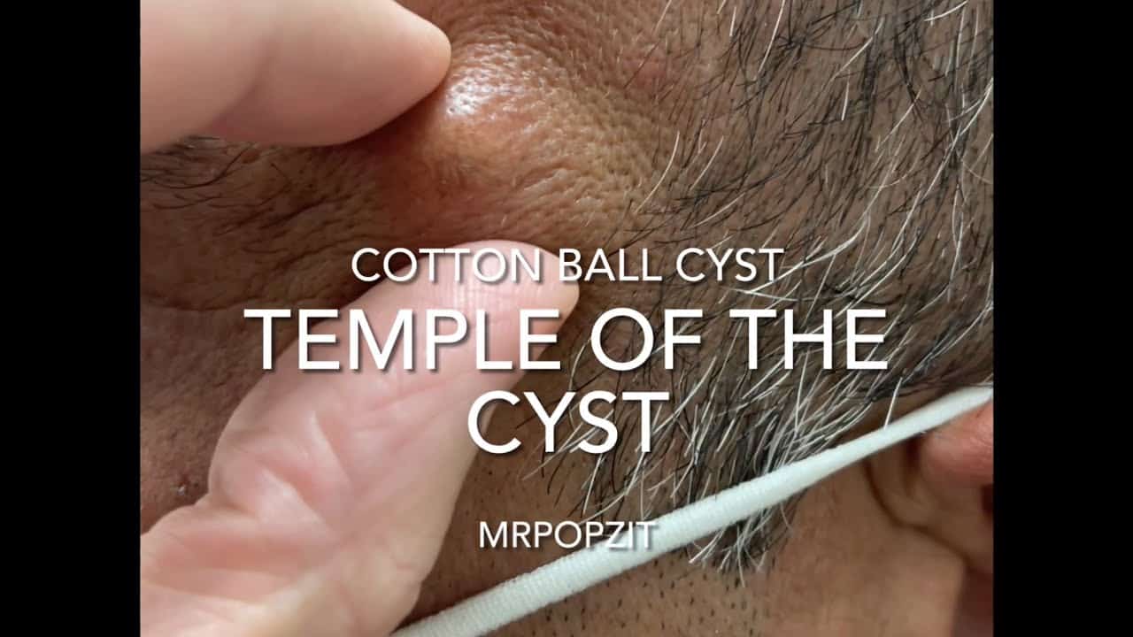 Cotton Ball Cyst. Temple of the cyst. Large cyst on temple looks like fluffy white cotton on inside.