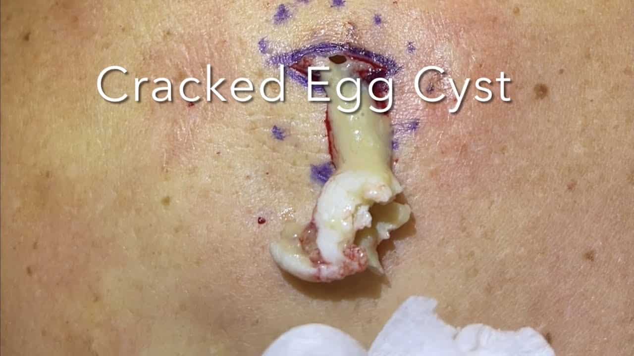 Cracked Egg Cyst. Large deep cyst popped and removed on back. Tracks down to deep pocket. MrPopZit.