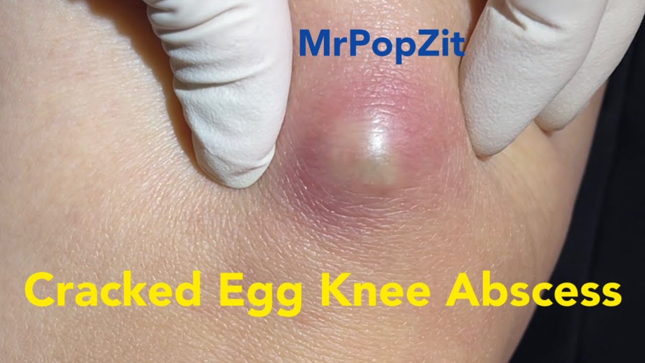 Cracked Egg Knee Abscess. Large mass on knee under pressure and painful. Pressure relieved.