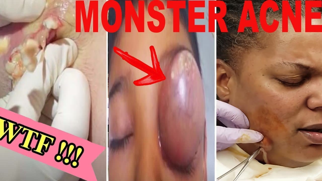 🔴 crazy abcess 🔴 popping huge blackheads and pimple popping 🔴 cysts and blackheads this week 🔴