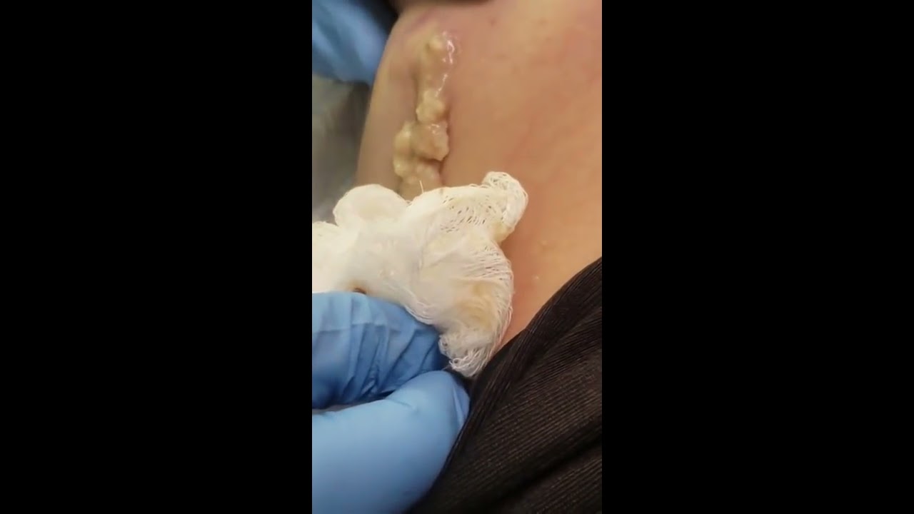 Crazy large cyst on armpit! #6